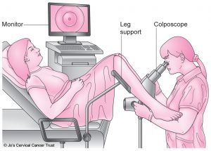 An illustration of a woman attending a colposcopy appointment. She is on a hospital bed with legs in supports while a health professional assess her cervix through a colposcope which connects to a screen showing the cervix.